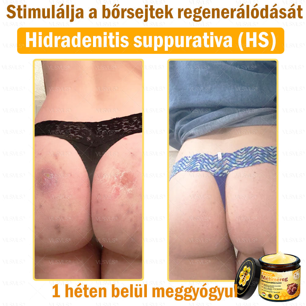 ⭐VLSVLS® Méhméreg Bőrhelyreállító Krém (👨⚕CE jóváhagyott)