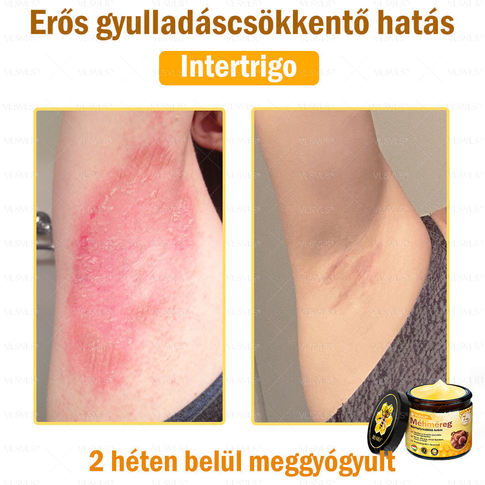 ⭐VLSVLS® Méhméreg Bőrhelyreállító Krém (👨⚕CE jóváhagyott)