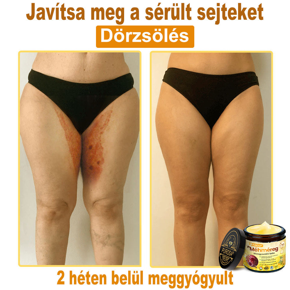 🎁PUROSA® Méhméreg Bőrmegújító Krém🐝|Teljes körű megoldás a makacs bőrproblémák, például az öregedés, ekcéma, hegek és pikkelysömör ellen
