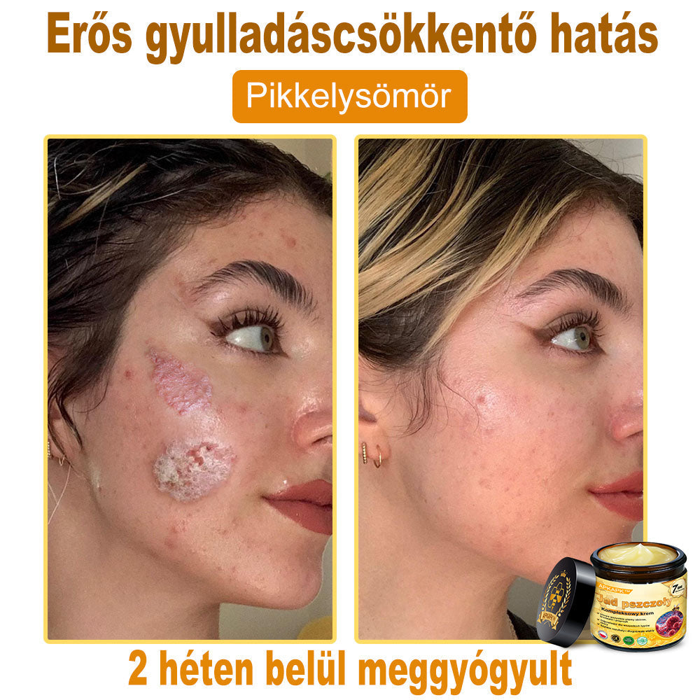 🎁PUROSA® Méhméreg Bőrmegújító Krém🐝|Teljes körű megoldás a makacs bőrproblémák, például az öregedés, ekcéma, hegek és pikkelysömör ellen