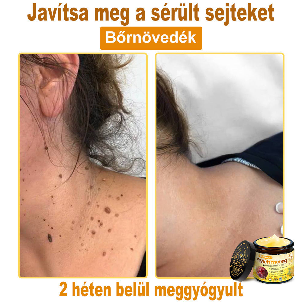 🎁PUROSA® Méhméreg Bőrmegújító Krém🐝|Teljes körű megoldás a makacs bőrproblémák, például az öregedés, ekcéma, hegek és pikkelysömör ellen