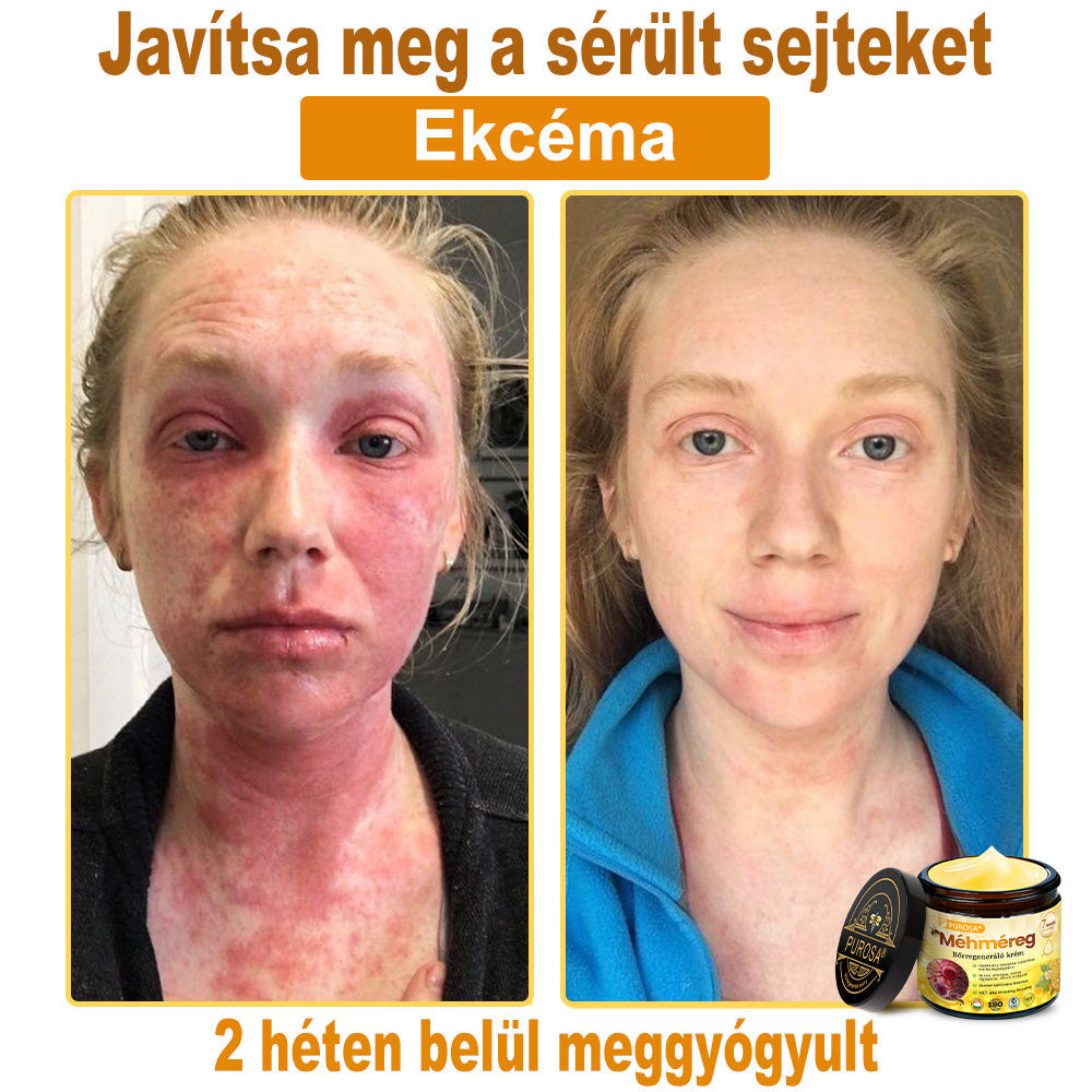 🎁PUROSA® Méhméreg Bőrmegújító Krém🐝|Teljes körű megoldás a makacs bőrproblémák, például az öregedés, ekcéma, hegek és pikkelysömör ellen