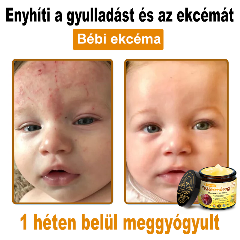 🎁PUROSA® Méhméreg Bőrmegújító Krém🐝|Teljes körű megoldás a makacs bőrproblémák, például az öregedés, ekcéma, hegek és pikkelysömör ellen