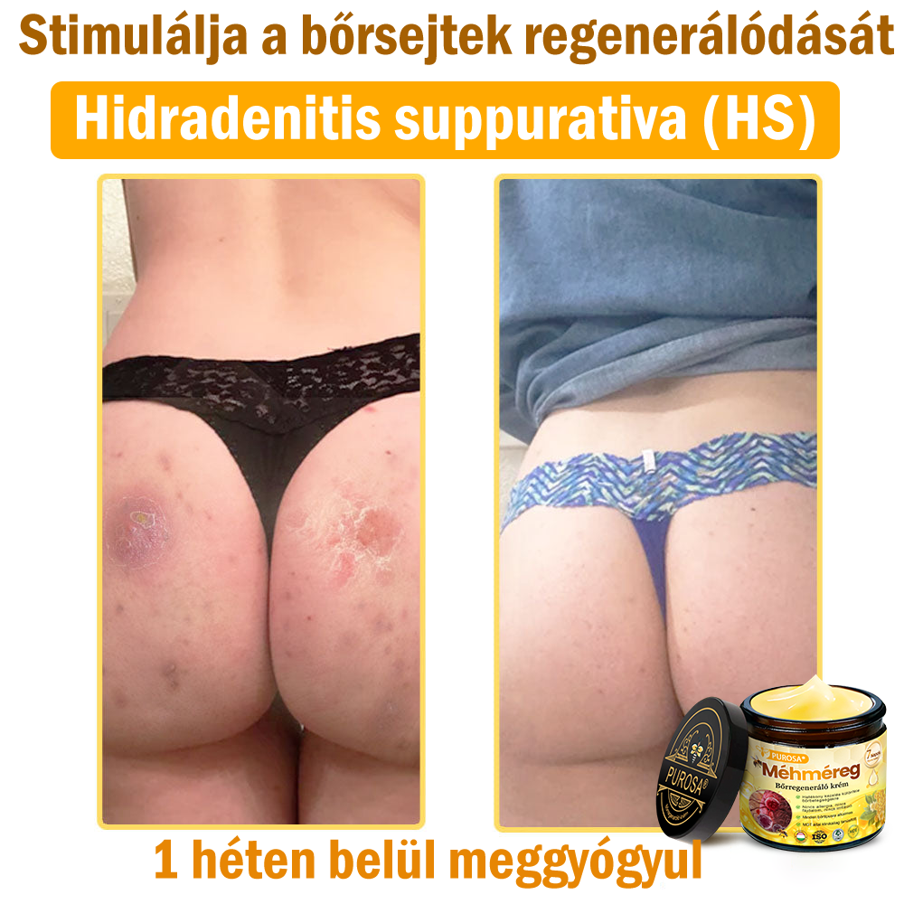 🎁PUROSA® Méhméreg Bőrmegújító Krém🐝|Teljes körű megoldás a makacs bőrproblémák, például az öregedés, ekcéma, hegek és pikkelysömör ellen