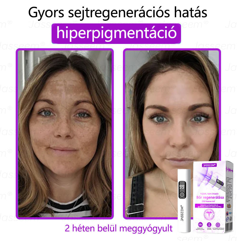🌟𝐉𝐚𝐬𝐬𝐞𝐞𝐦® Zaawansowany nieinwazyjny laser CO₂ do naprawy skóry 🎉 (Delikatnie usuwa brodawki, znamiona, plamy starcze i narośla skórne – bez bólu, bez zamieszania!)🚀