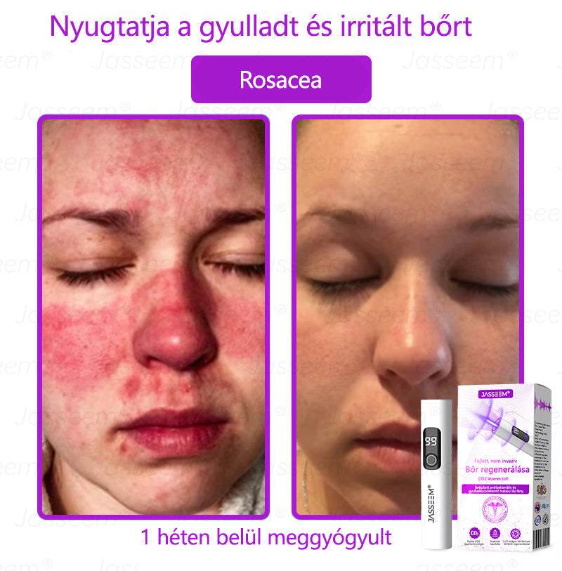 🌟𝐉𝐚𝐬𝐬𝐞𝐞𝐦® Zaawansowany nieinwazyjny laser CO₂ do naprawy skóry 🎉 (Delikatnie usuwa brodawki, znamiona, plamy starcze i narośla skórne – bez bólu, bez zamieszania!)🚀