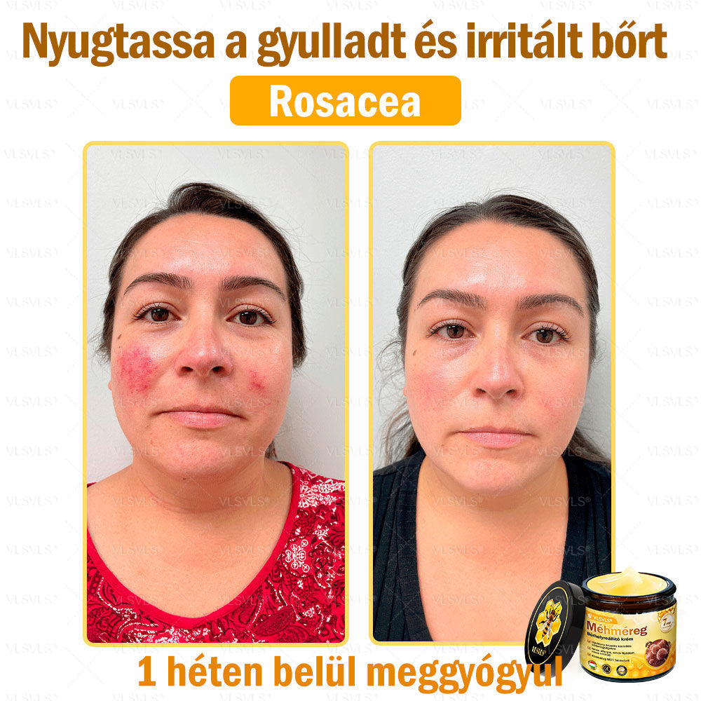 ⭐VLSVLS® Méhméreg Bőrhelyreállító Krém (👨⚕CE jóváhagyott)