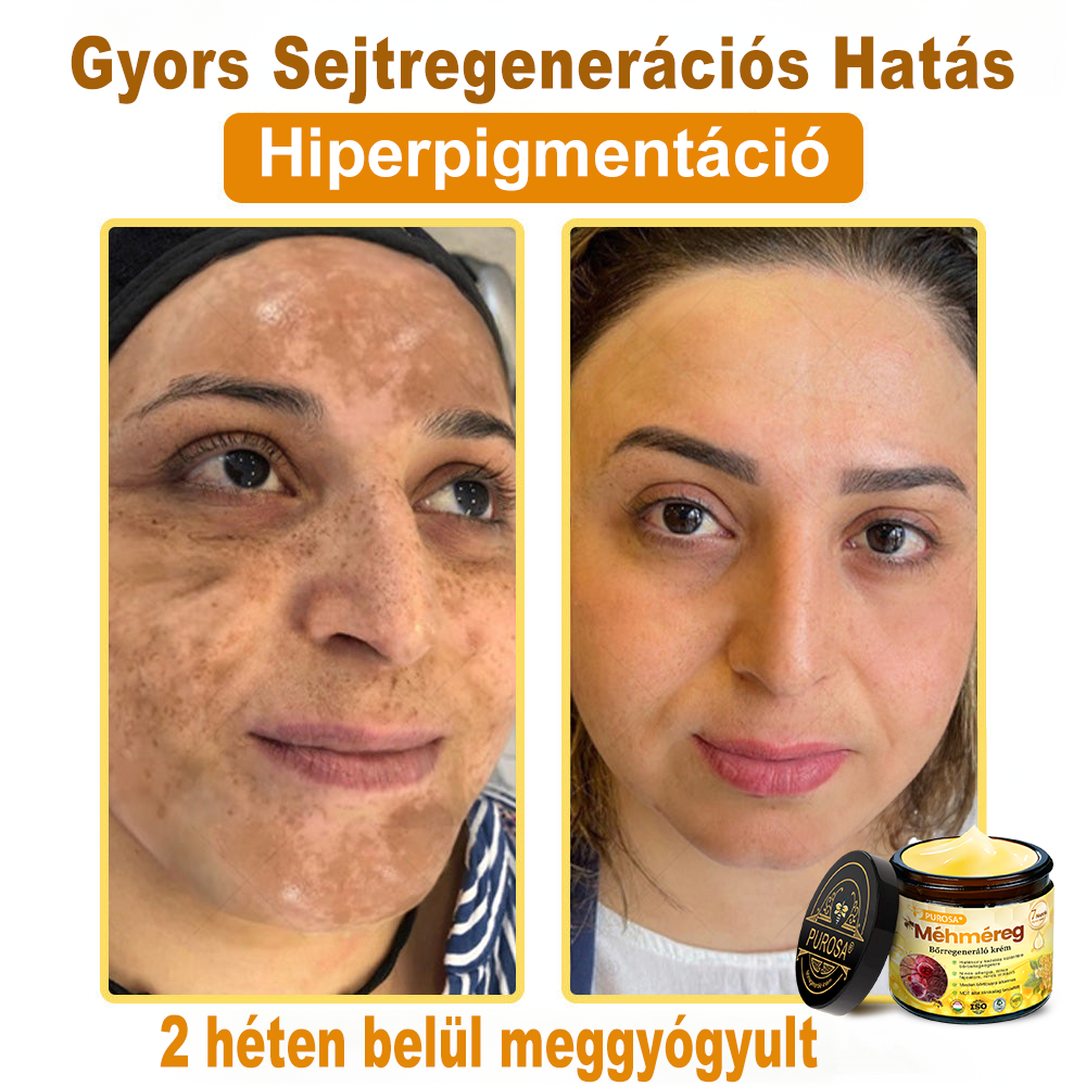 🎁PUROSA® Méhméreg Bőrmegújító Krém🐝|Teljes körű megoldás a makacs bőrproblémák, például az öregedés, ekcéma, hegek és pikkelysömör ellen