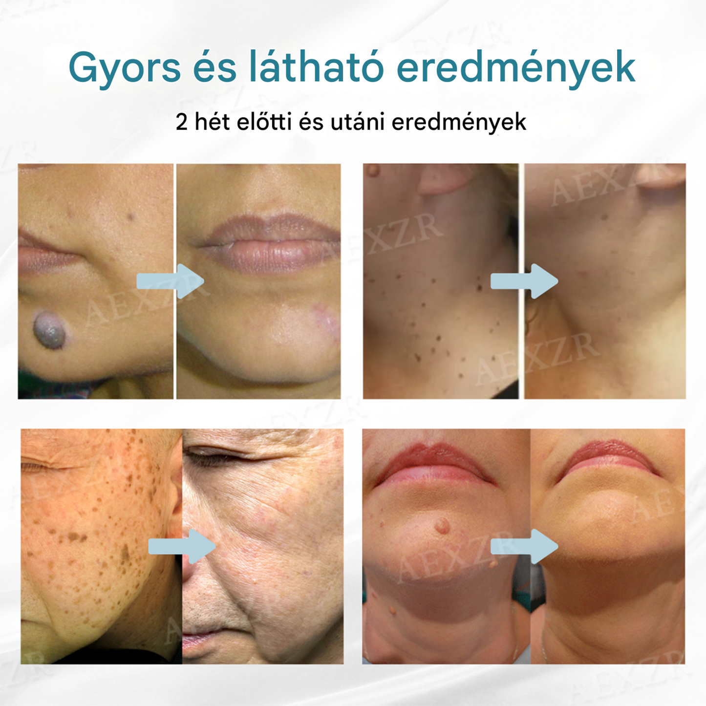 ✨Bikenda® non-invazív anyajegy- és szemölcseltávolító lézertoll💎
