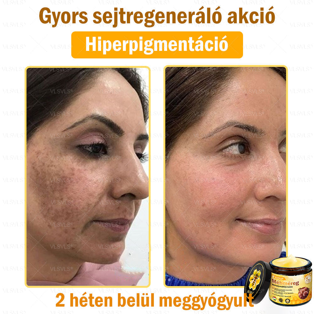 ⭐VLSVLS® Méhméreg Bőrhelyreállító Krém (👨⚕CE jóváhagyott)