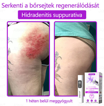 🌟𝐉𝐚𝐬𝐬𝐞𝐞𝐦® Zaawansowany nieinwazyjny laser CO₂ do naprawy skóry 🎉 (Delikatnie usuwa brodawki, znamiona, plamy starcze i narośla skórne – bez bólu, bez zamieszania!)🚀
