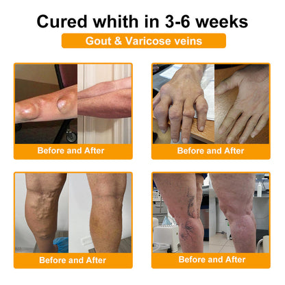 🏆 TLOPA® Botulinum Toxin és Méhméreg Fájdalomcsillapító Csontgyógyító Krém🐝 🔥(Kifejezetten időseknek & ortopéd szakorvosok ajánlásával)🦴