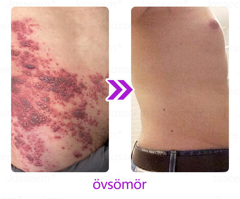 🌟𝐉𝐚𝐬𝐬𝐞𝐞𝐦® Zaawansowany nieinwazyjny laser CO₂ do naprawy skóry 🎉 (Delikatnie usuwa brodawki, znamiona, plamy starcze i narośla skórne – bez bólu, bez zamieszania!)🚀