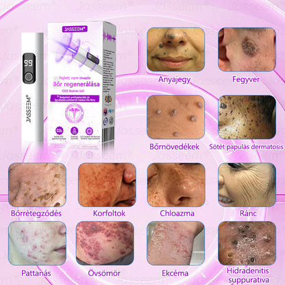 🌟𝐉𝐚𝐬𝐬𝐞𝐞𝐦® Zaawansowany nieinwazyjny laser CO₂ do naprawy skóry 🎉 (Delikatnie usuwa brodawki, znamiona, plamy starcze i narośla skórne – bez bólu, bez zamieszania!)🚀