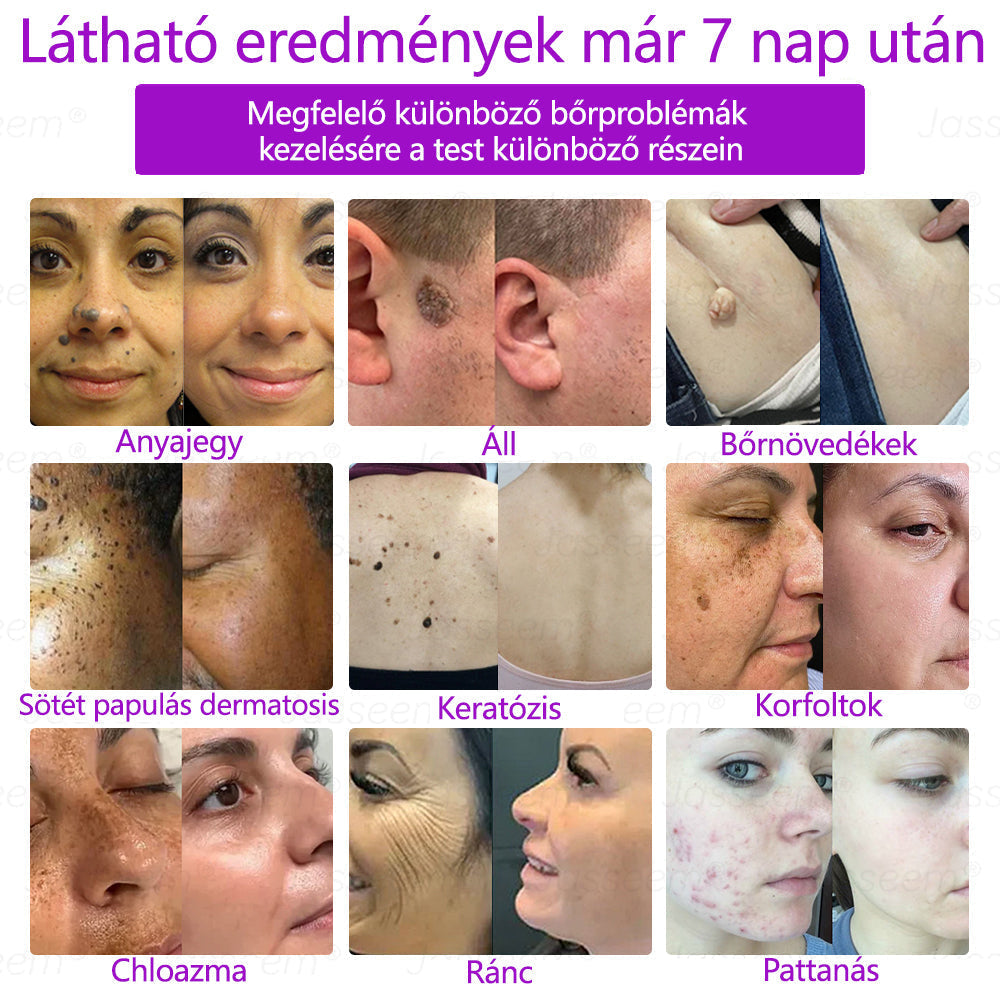 🌟𝐉𝐚𝐬𝐬𝐞𝐞𝐦® Zaawansowany nieinwazyjny laser CO₂ do naprawy skóry 🎉 (Delikatnie usuwa brodawki, znamiona, plamy starcze i narośla skórne – bez bólu, bez zamieszania!)🚀