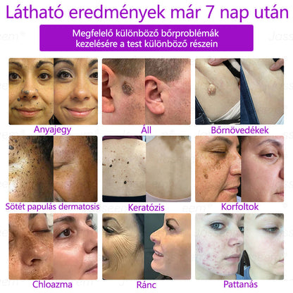 🌟𝐉𝐚𝐬𝐬𝐞𝐞𝐦® Zaawansowany nieinwazyjny laser CO₂ do naprawy skóry 🎉 (Delikatnie usuwa brodawki, znamiona, plamy starcze i narośla skórne – bez bólu, bez zamieszania!)🚀