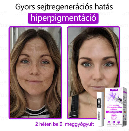 🌟𝐉𝐚𝐬𝐬𝐞𝐞𝐦® Zaawansowany nieinwazyjny laser CO₂ do naprawy skóry 🎉 (Delikatnie usuwa brodawki, znamiona, plamy starcze i narośla skórne – bez bólu, bez zamieszania!)🚀