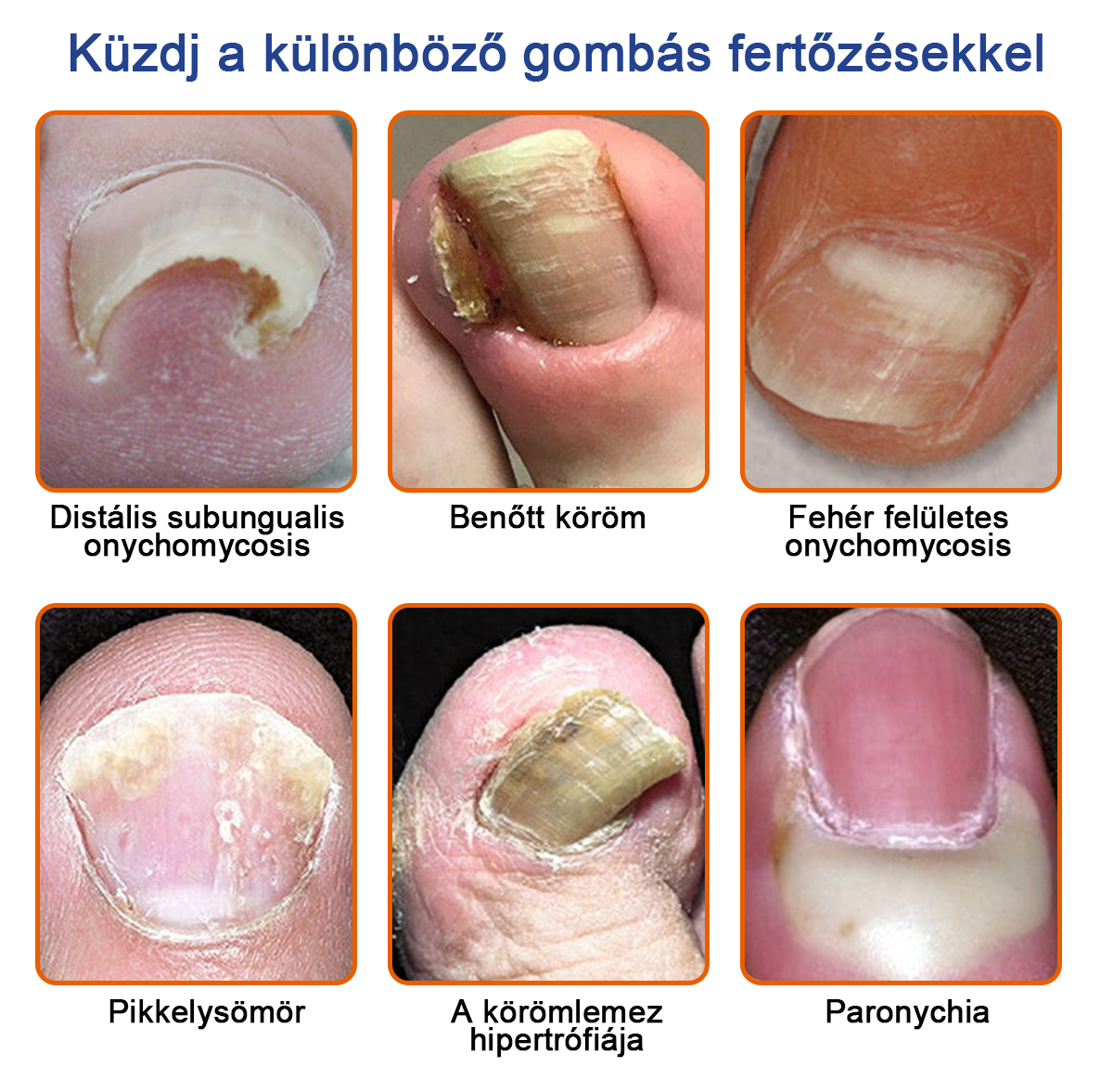 🐝Furzero™ Méhméreg Körömgomba Kezelőoldat: Teljes megoldás a körömgomba problémájára💎