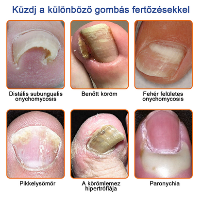 🐝Furzero™ Méhméreg Körömgomba Kezelőoldat: Teljes megoldás a körömgomba problémájára💎