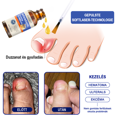 🐝Furzero™ Méhméreg Körömgomba Kezelőoldat: Teljes megoldás a körömgomba problémájára💎